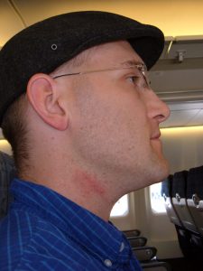 Man on plane with irritated skin from shaving rash